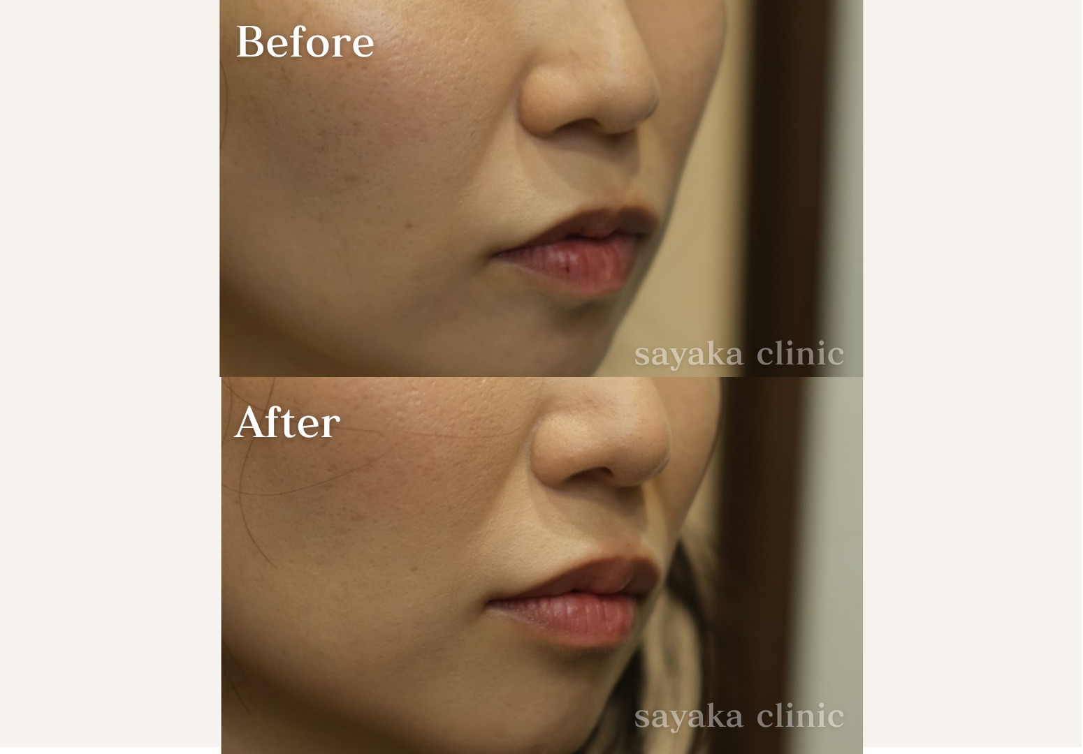 人中ボトックス 症例 Before / After