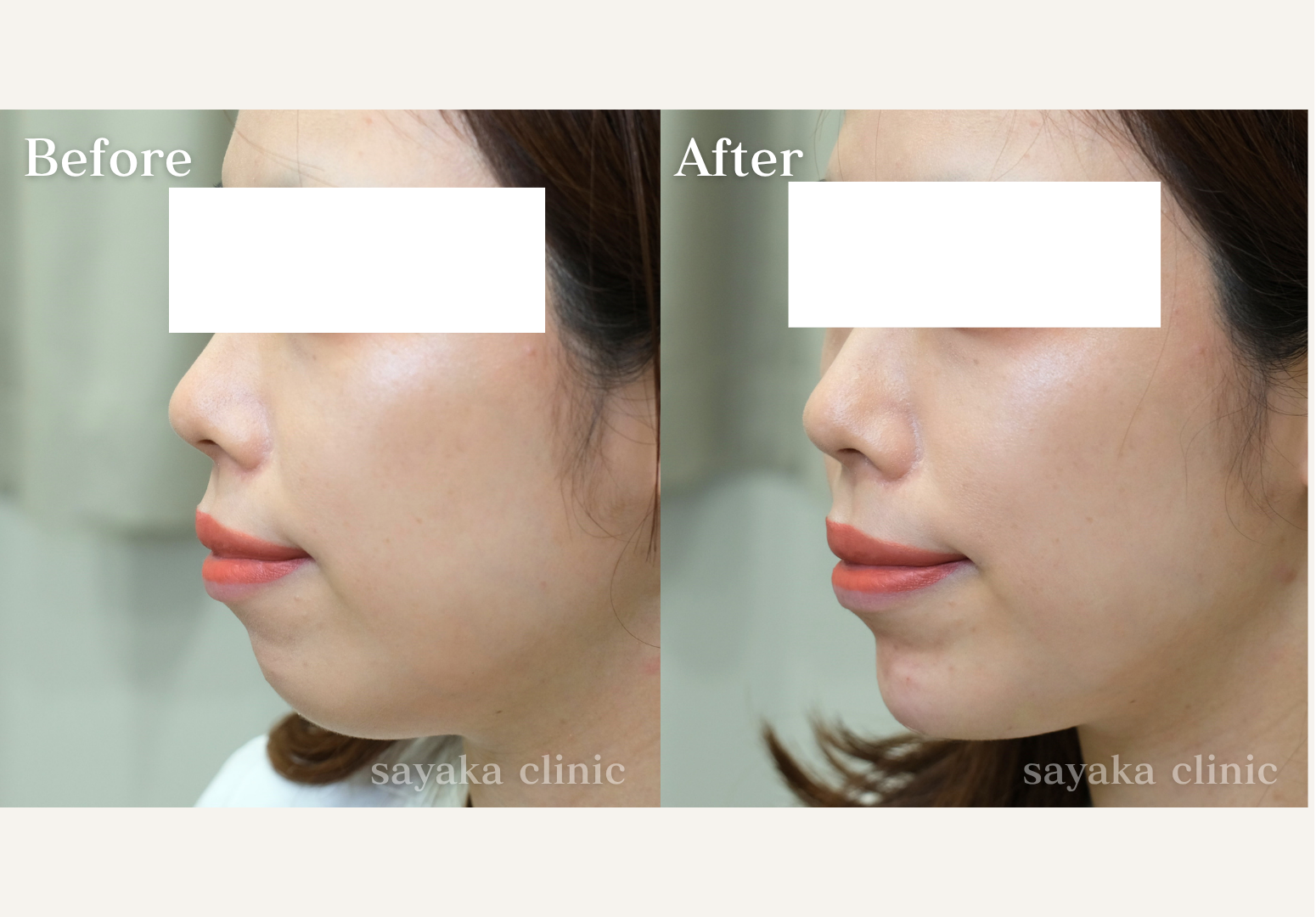 顎ヒアルロン酸 症例 Before / After