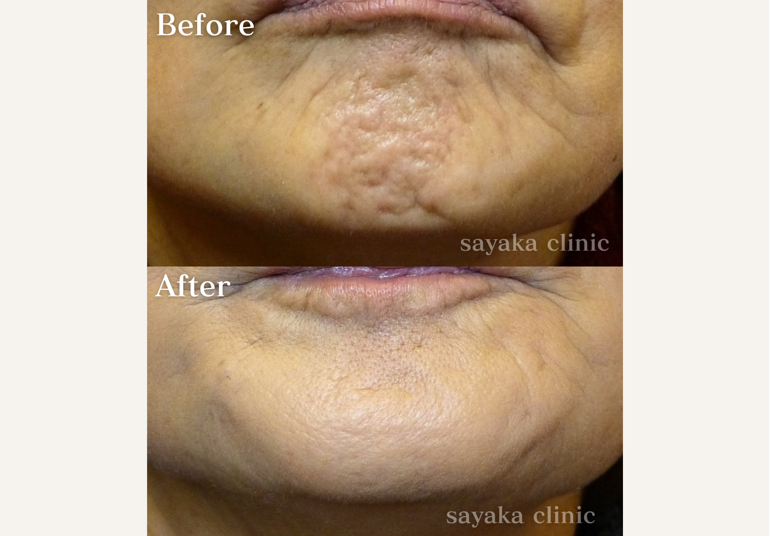 あごボトックス 症例 Before / After