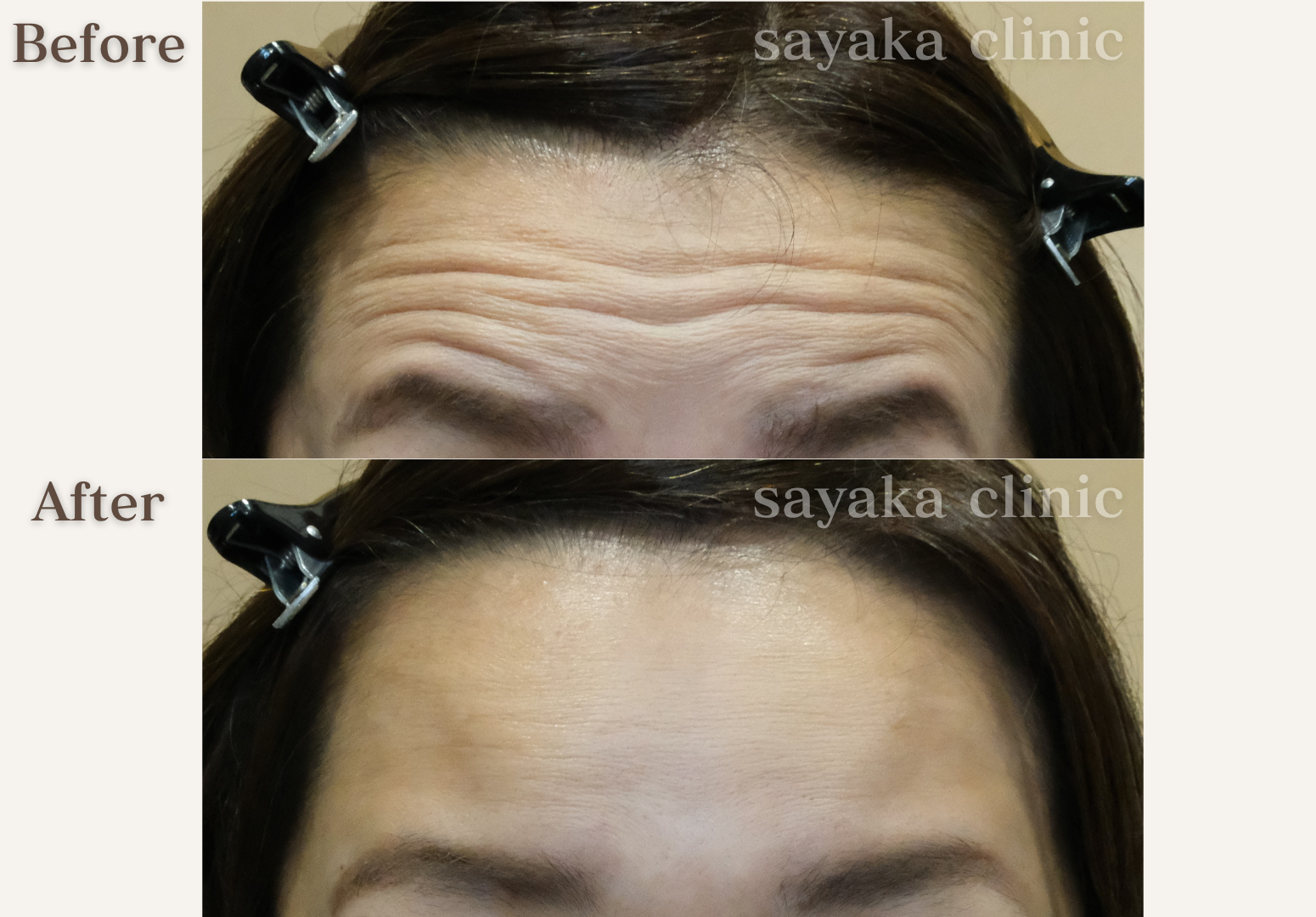 額ボトックス 症例 Before / After