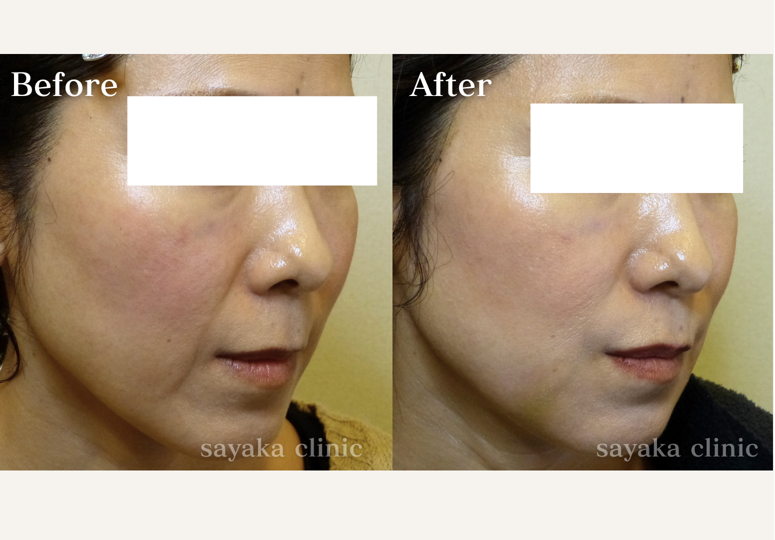 ほうれい線・マリオネットヒアルロン酸 症例 Before / After