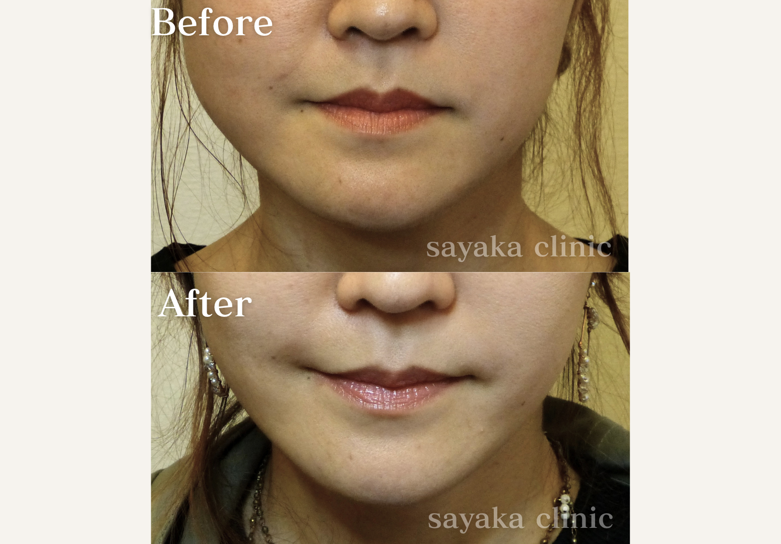 小顔ボトックス 症例 Before / After